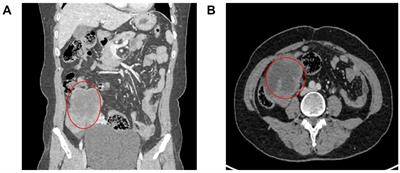 Application of 3D reconstruction and 3D printing technology in advanced ovarian cancer surgery: a retrospective study